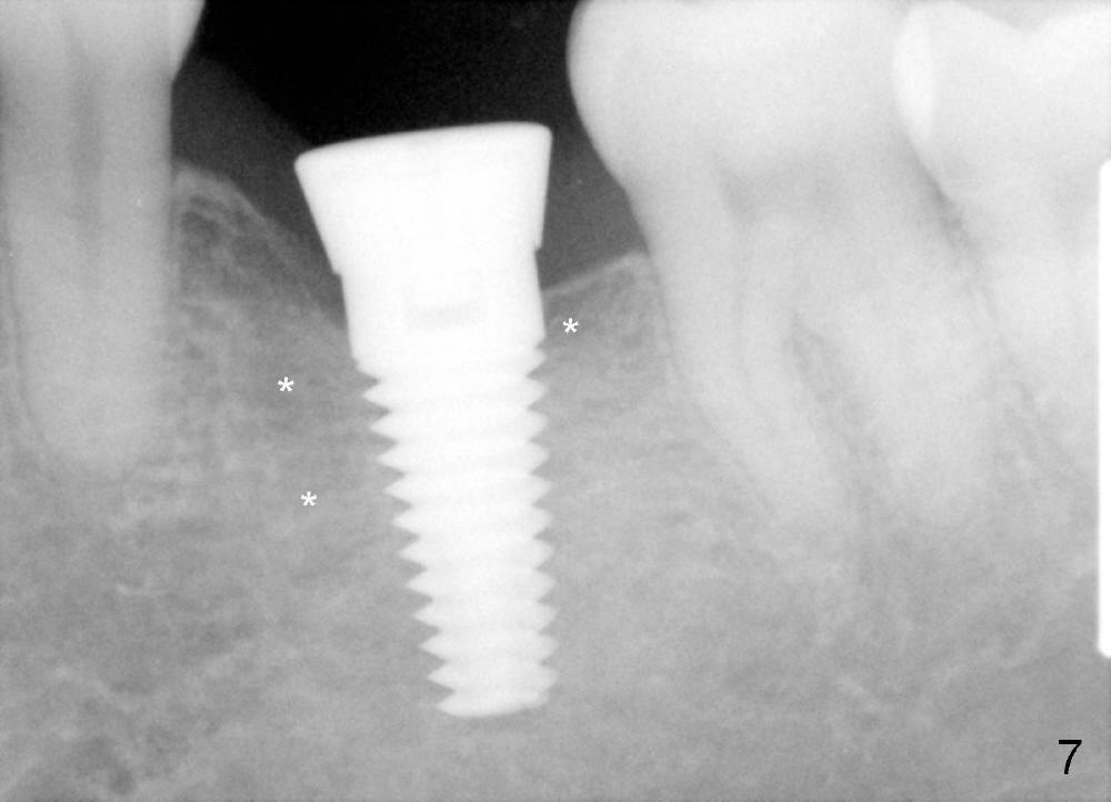 Platelet reduction and extraction, implant, Dental Education Lecture